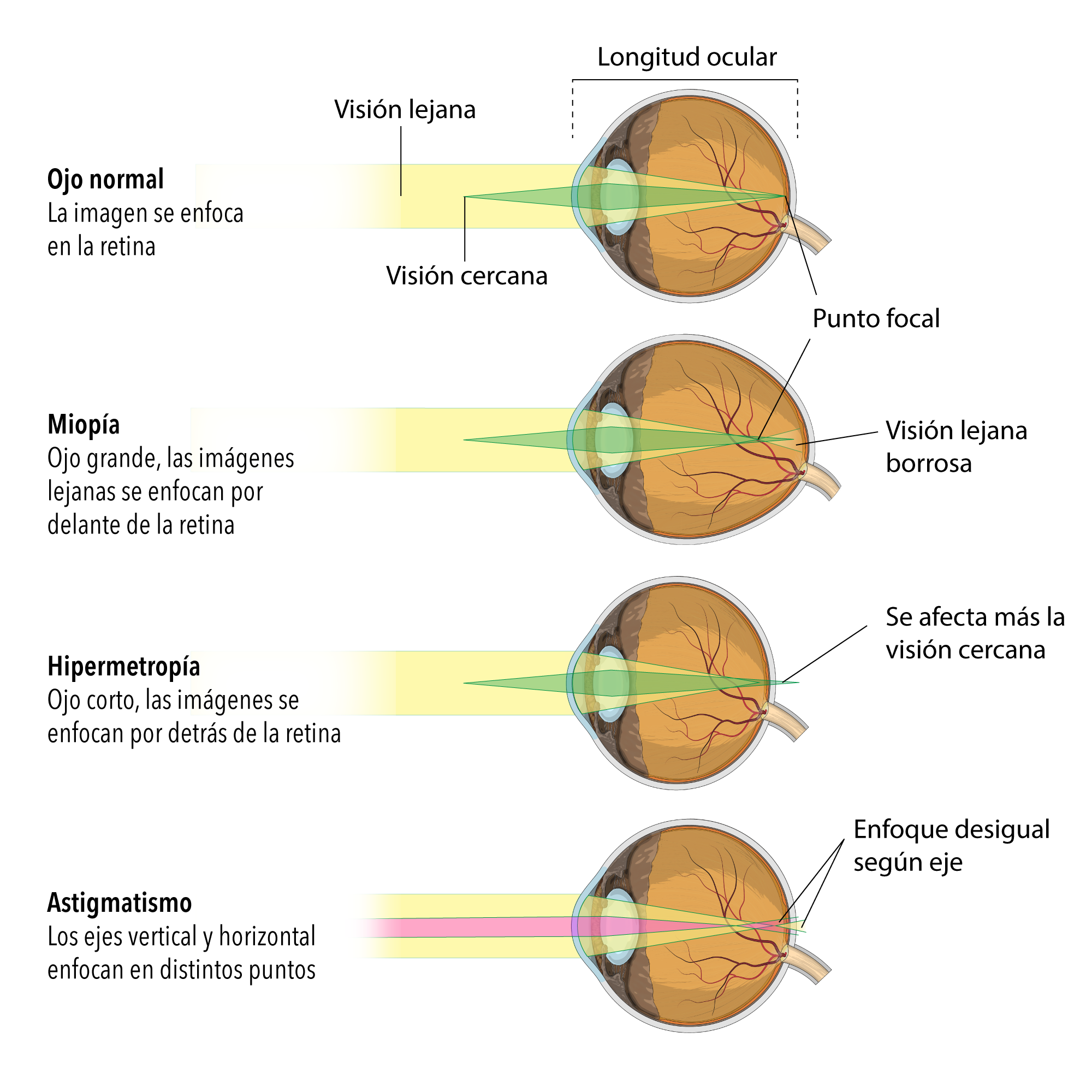 miopía presbicia y astigmatismo