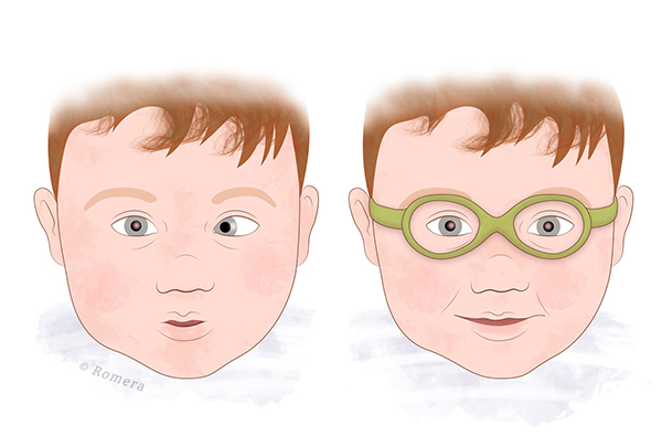 Lentes para sales bebes con estrabismo
